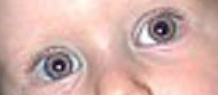 Example for the “Red Eye Removal” filter